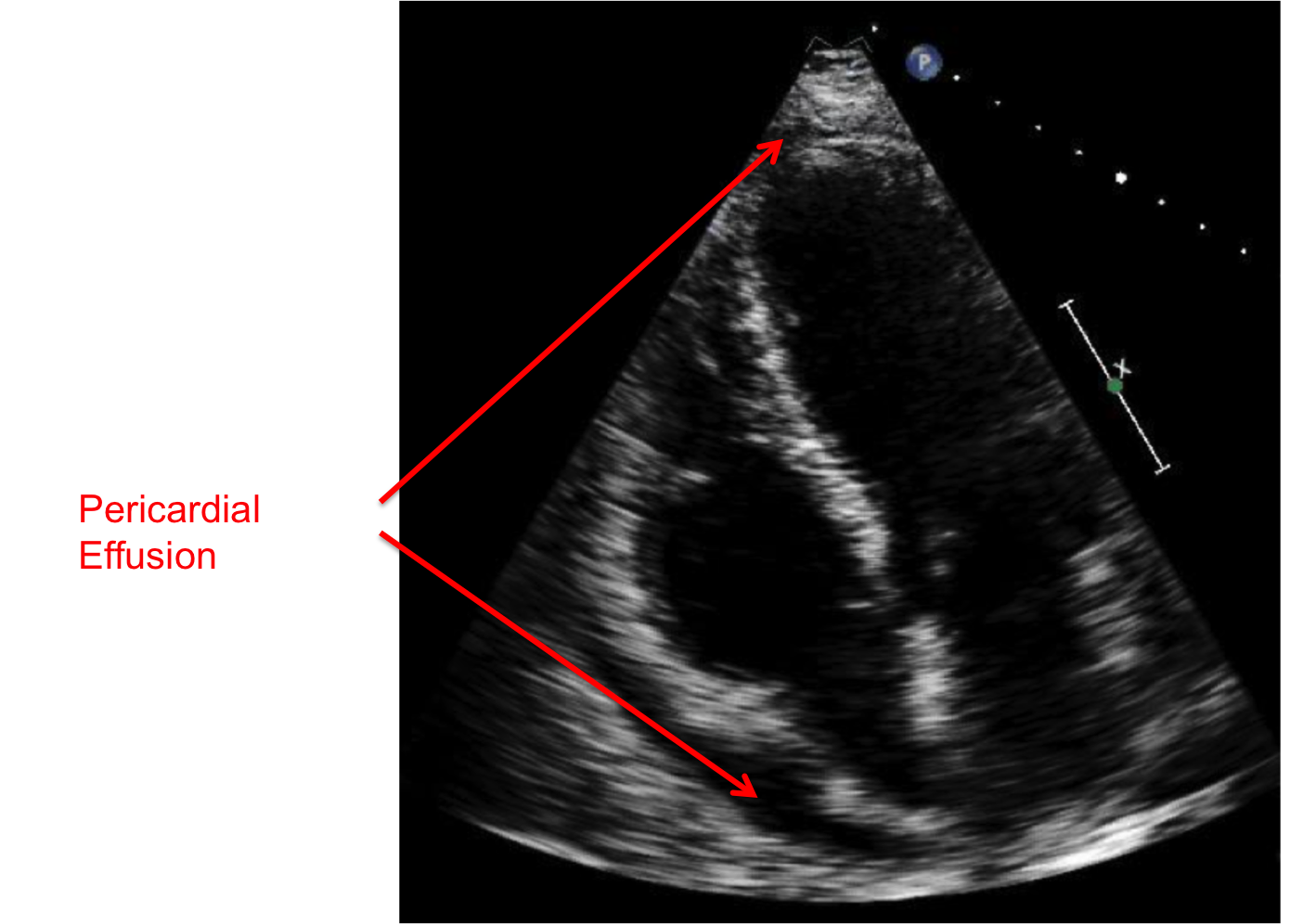 Acute Pericarditis 101 SelfTreatment Leads to Mistreatment American
